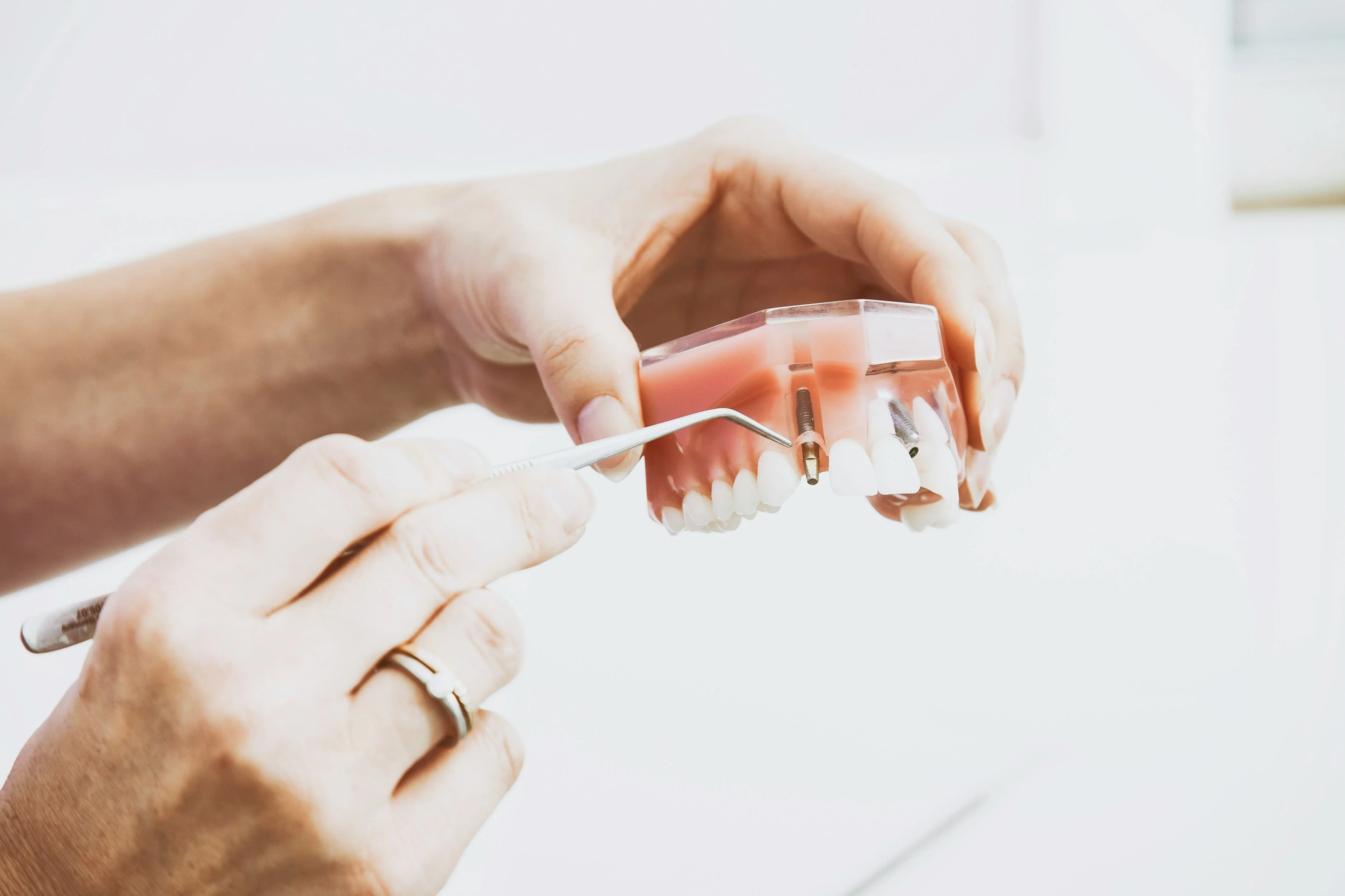 Implantes dentales: qué son y cuándo se recomiendan